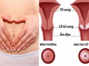 Ung thư cổ tử cung: Nguyên nhân, triệu chứng và cách phòng ngừa